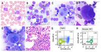 Chronic myelomonocytic leukemia with KRAS mutation