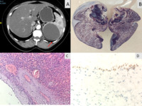 Mesothelial splenic cyst: An insight into rare phenomenon