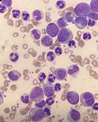 Chronic myeloid leukaemia 4