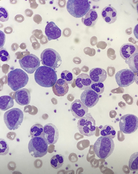 Chronic myeloid leukaemia 1