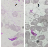 Gametocytes of Plasmodium falciparum