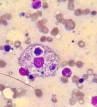 Hemophagocytosis