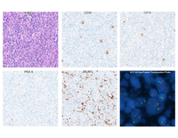 Classic Hodgkin Lymphoma with IGH::CCND1 Rearrangement: Evidence of Clonal Relationship with Preceding Mantle Cell Lymphoma