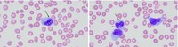 Blue-Green Inclusions are Correlated with Acute Liver Injury in a Case of Acute Myeloid Leukemia