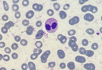 Pseudo-Pelger-Huet neutrophil presence due to reactive leukocytosis caused by infection 1