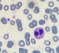 Pseudo-Pelger-Huet neutrophil presence due to reactive leukocytosis caused by infection 2