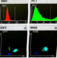 Pseudo-Pelger-Huet neutrophil presence due to reactive leukocytosis caused by infection 3