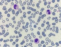 Pseudo-Pelger-Huet neutrophil presence due to reactive leukocytosis caused by infection 4