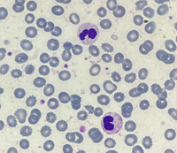 Pseudo-Pelger-Huet neutrophil presence due to reactive leukocytosis caused by infection 5