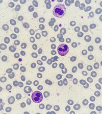 Pseudo-Pelger-Huet neutrophil presence due to reactive leukocytosis caused by infection 6