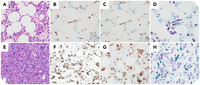 T-large granular lymphocytic leukemia transformation to peripheral T-cell lymphoma