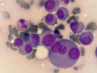 Sheet of Plasma Cells 1