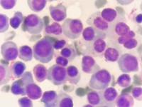 Sheet of Plasma Cells 2