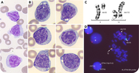 Acute myeloid leukemia mimicking mature lymphoid morphology
