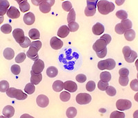 Hypersegmented neutrophil