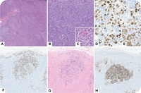 KSHV/HHV8-positive germinotropic lymphoproliferative disorder in a patient with HIV