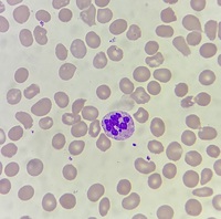Hypersegmented neutrophil with Barr body