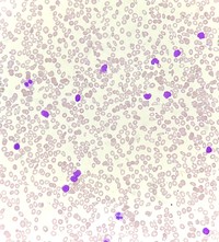 Chronic lymphocytic leukemia with flowcytometry 1