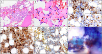 Plasma Cell Neoplasm with Prominent Russell Bodies