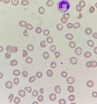 Schistocytes
