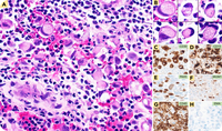 Classic Hodgkin lymphoma with signet ring cell morphology mimicking adenocarcinoma