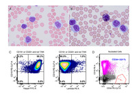 Atypical Chronic Lymphocytic Leukemia Cells With Auer Rods-like Inclusions
