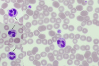 MYH9-related disorder