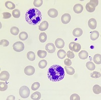 Marked Toxic Changes in Neutrophils