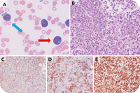 NPM1-mutated acute myeloid leukemia with marked erythroid and megakaryocytic differentiation