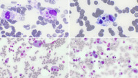 IgM myeloma-triggered HLH
