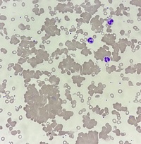 Cold agglutinin disease 1