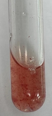 Cold agglutinin disease 3