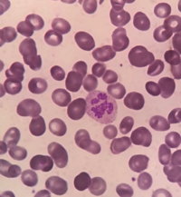 Hypersegmented Neutrophil in Megaloblastic Change