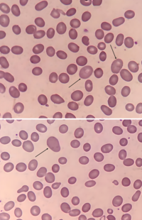 Macro‑ovalocyte 1