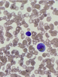 Golden-yellow bilirubin crystals within the cytoplasm of monocytes