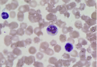 Golden-yellow bilirubin crystals within the cytoplasm of neutrophils