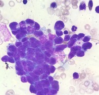 Bone marrow aspirate in metastatic neuroblastoma demonstrating a classic Homer-Wright rosette 2