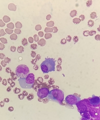 Plasma cell(Flame cell)