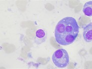 Trinucleated plasma cell