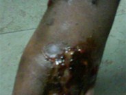 Warfarin Induced Skin Necrosis